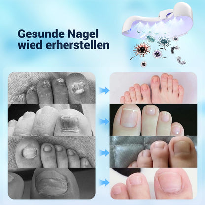 PureLite - Nagelpilz Lasertherapie